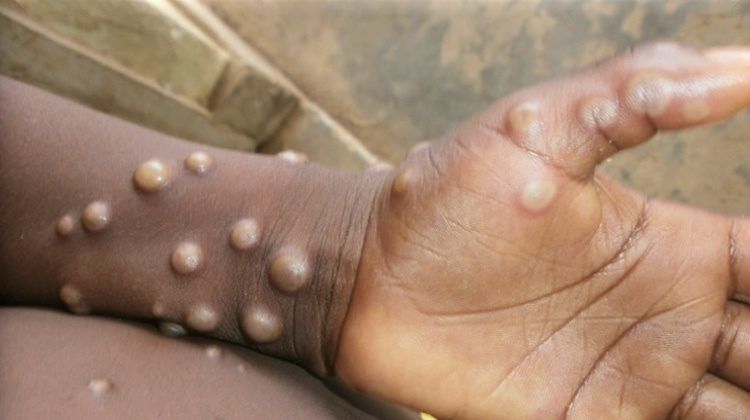 Morocco Sees First Mpox Case in North Africa During Emergency – CDC